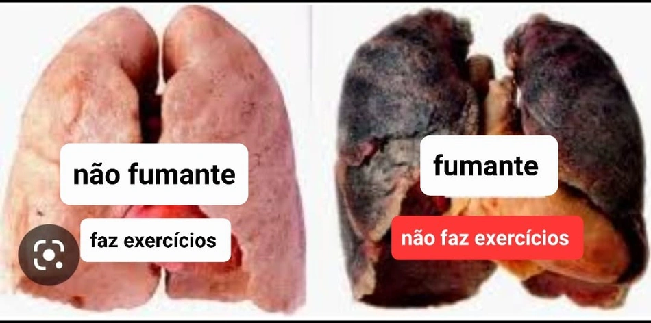 Imagem de um pulmão de uma pessoa que não fuma e de uma pessoa que fuma