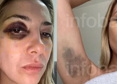 Hematomas que a ex-primeira dama da Argentina sofreu